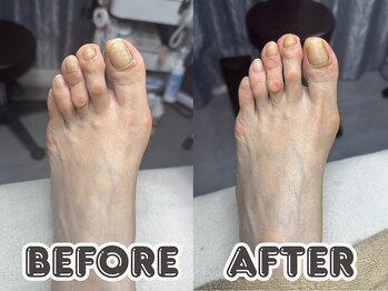 ポドロ ウィズ ニコルル 大阪天満店(PoDoLo with Nicolulu)/【足指のたこ】フットケア大阪