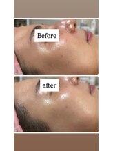 ココ(COCO)/シミケア、ビフォー、アフター☆