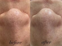 メリハリラボ 調布店(MeriHari.Lab)/1回before after