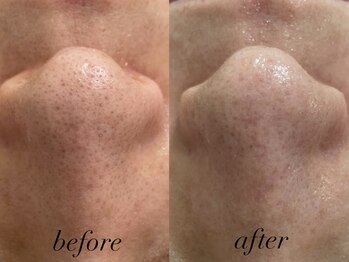 リスポアラボ(LIS PORE.LAB)/1回before after