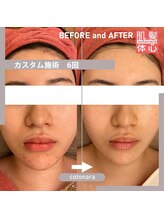 アンナカルナ(AnnaCarna)/繰り返す肌荒れ対策にお勧め