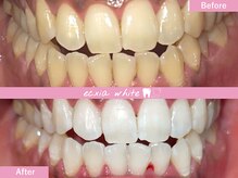 エクシアホワイトニング 札幌中島公園店/Before After［ホワイトニング］