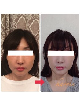 顔凛(カオリン)/50代女性の小顔矯正