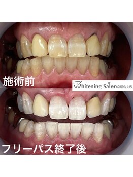 ホワイトニングサロン 京都烏丸店/ホワイトニング施術例