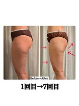 スターエステ(STAR ESTHE)/下半身1回目→7回目