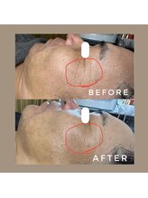 カウニス るる(kaunis)/【ララピール】Before After