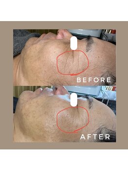 カウニス るる(kaunis)/【ララピール】Before After