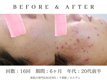 ロエヴェ(ROEWE)/ニキビ改善・毛穴ケア・肌質改善