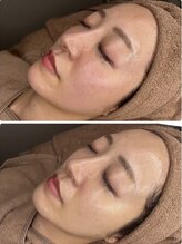 ホワイトアクア 梅田本店(WHITE AQUA)/ララピール/大阪/梅田/毛穴/小顔