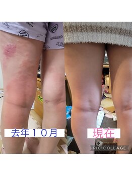 アロハウス(ALOHOUSE)/肌も改善へ。