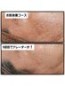 超肌質改善コース【半額】クーポン