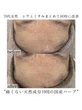 ヴェルシック(Belchic)/くすみとシワまとめて改善