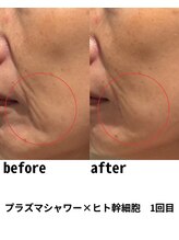 ラノン(LANON)/ビフォーアフター9