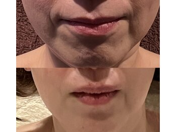 エン(EN)/口回りのシワが気になるあなたへ