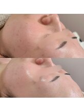 オンド(OND)/最新ダクトピール+美容液導入