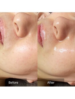 ヒール(heal)/40代　毛穴、くすみ悩み