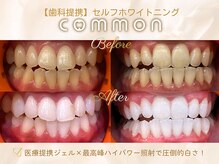 セルフホワイトニングコモン 藤枝店(self whitening common)