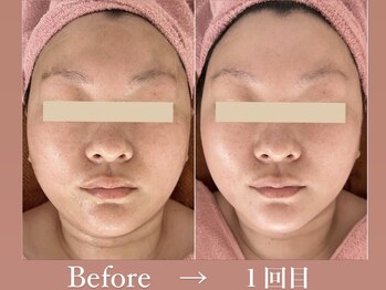 エフプラネット(F Planet)/フェイシャル