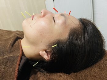 ケンビ(Kenbi)の写真/理想のお顔へ導く♪美容鍼でしわ・たるみ・ほうれい線を根本ケア◎