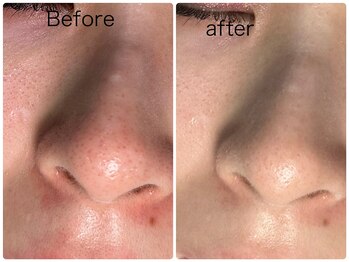 ルミネル 名古屋新栄(Luminelle)/毛穴洗浄