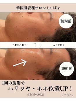 ラ リリー ステラ(La Lily stella)/一回でハリツヤ・リフトアップ!