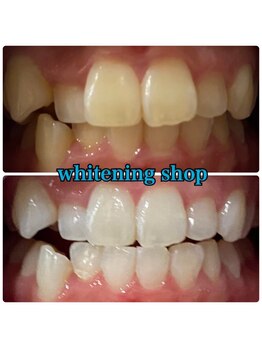 ホワイトニングショップ 長岡京店/ホワイトニングビフォーアフター