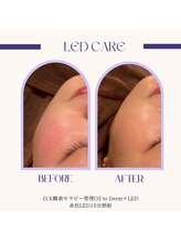 ポピン(POPIN)/白玉酸素管理＋赤色LED15分照射