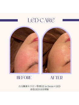 ポピン(POPIN)/白玉酸素管理+赤色LED15分照射