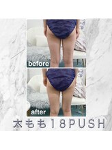 ハロ 南青山(HALO)/脂肪分解スタンプ太もも18P