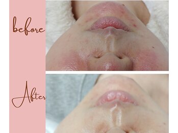 エンジェライト(Angelicht)/Before→After