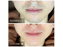カーロ(CARO)の雰囲気（レディースはもちろん、キッズ・メンズ脱毛も得意としています。）