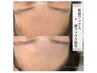 【眉毛＆フェイシャル額】アイブロウWax脱毛1回＋額ワックス脱毛