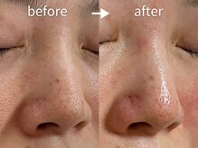 アルカンシエル(arcenciel)/毛穴改善コース