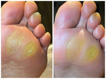 ハロースック 六本木(Hellossook)/次世代足裏ケア