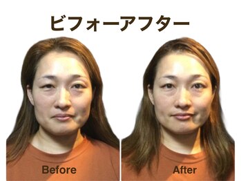 ミクロスポーツ整骨院(MICRO SPORTS整骨院)/【befor/after】40代〔歪み〕