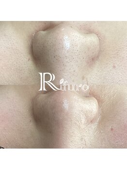 リフロ(Rifuro)の写真/韓国式３D毛穴洗浄は【メンズにもおすすめの毛穴洗浄】頑固な汚れもごっそり取り除く！憧れの毛穴レス肌へ