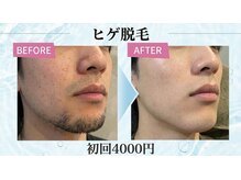ディシェーレ アストの雰囲気（効果◎メンズひげ脱毛￥10000→）