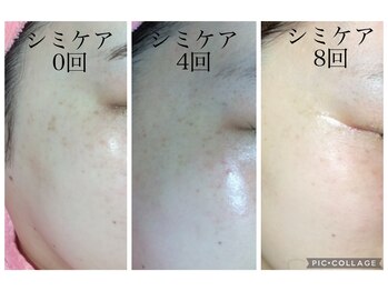 ロッコ(Rocco)/濃くなる前に予備軍もシミケア