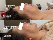 キーオブフェイス(Key of Face)/お悩み【くすみ+顔全体たるみ】