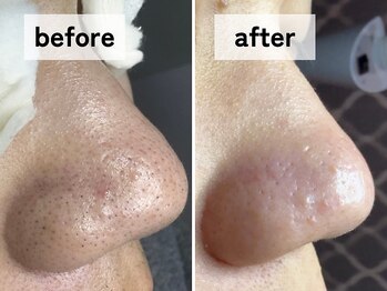 エアル(earu.)/BA|毛穴ケア|ピーリング|高円寺