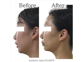 プランツ(PLANTS)/30代／１回／小顔・二重顎