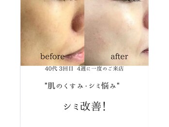 シミリセット 名駅(シミReset)/肌色変化あり