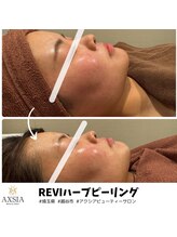 アクシア ビューティー サロン(AXSIA)/【ハーブピーリング】