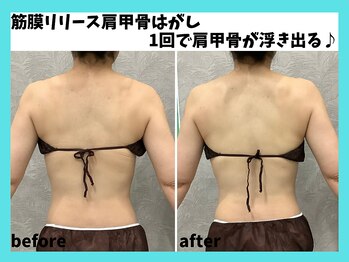 マーブル/筋膜リリース肩甲骨はがし