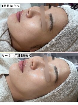 ソワナ(soina)/【神楽坂駅/フェイシャル/毛穴】