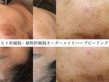 ライリー(Rairy)の雰囲気（天然国産100%×ヒト幹オーダーメイドハーブピーリング）