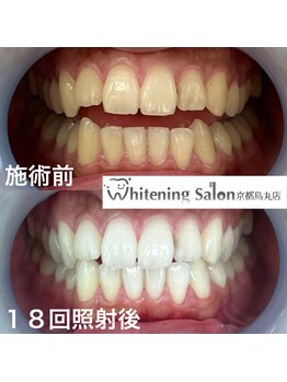 ホワイトニングサロン 京都烏丸店/ホワイトニング施術例