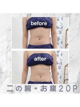 ハロ 南青山(HALO)/脂肪分解スタンプ20push