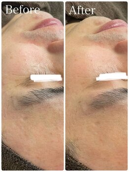 ビトタン 倉敷本店(+美to鍛)/ハーブピーリング/1回