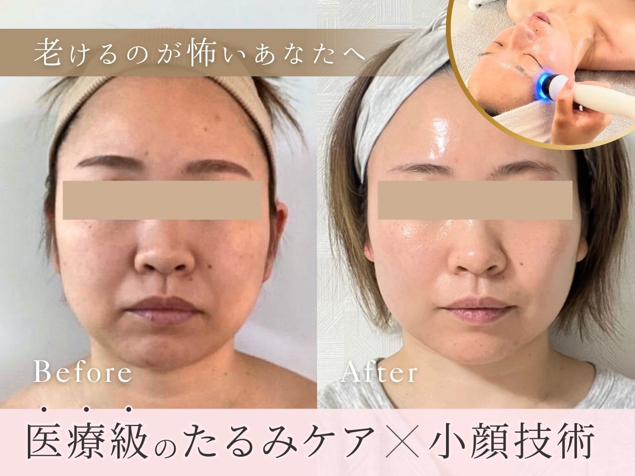 肌質改善エステサロン♡ 六十谷駅でピーリングが人気のエステサロン｜ホットペッパービューティー